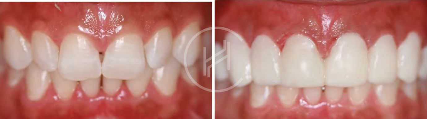 dental lumineer treatment before and after photo