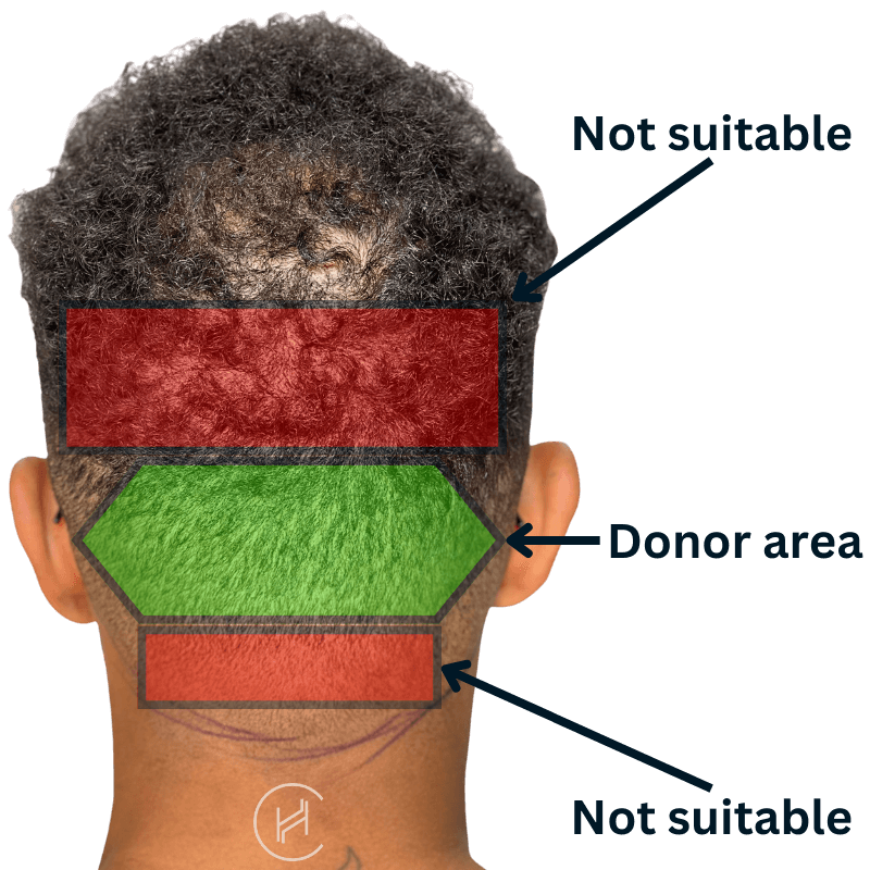 donor area hair transplant safe and risky zones picture