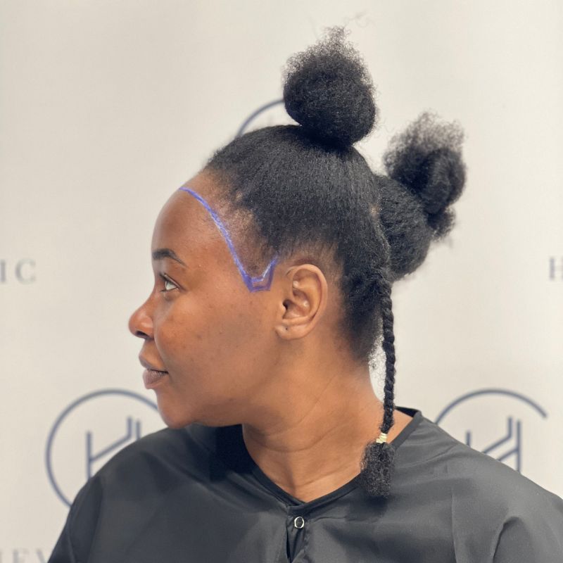 female hair transplant patient side angle
