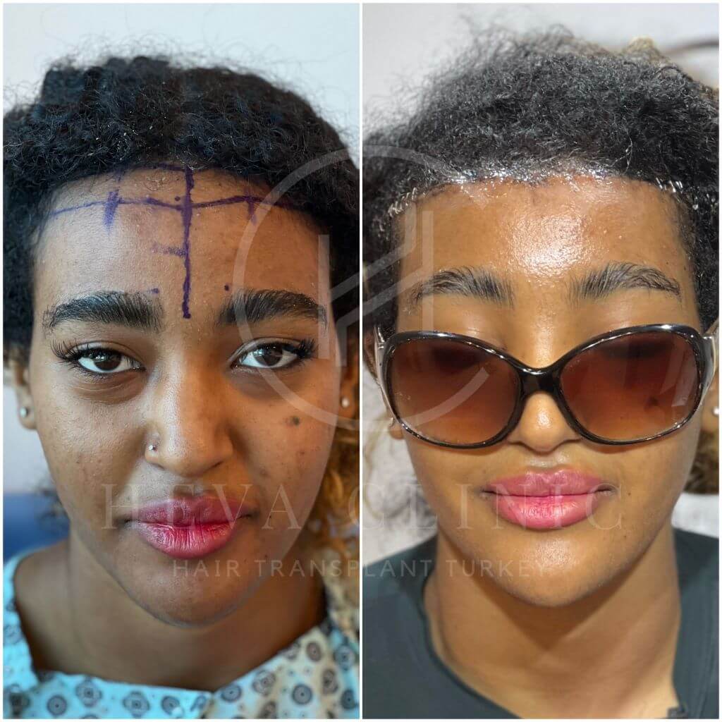 Forehead Reduction (Hairline Lowering) in Turkey - Costs in 2025 - Heva