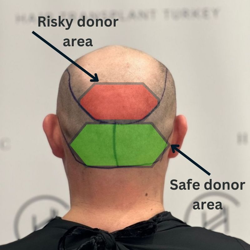 hair transplant donor area risky and safe zones