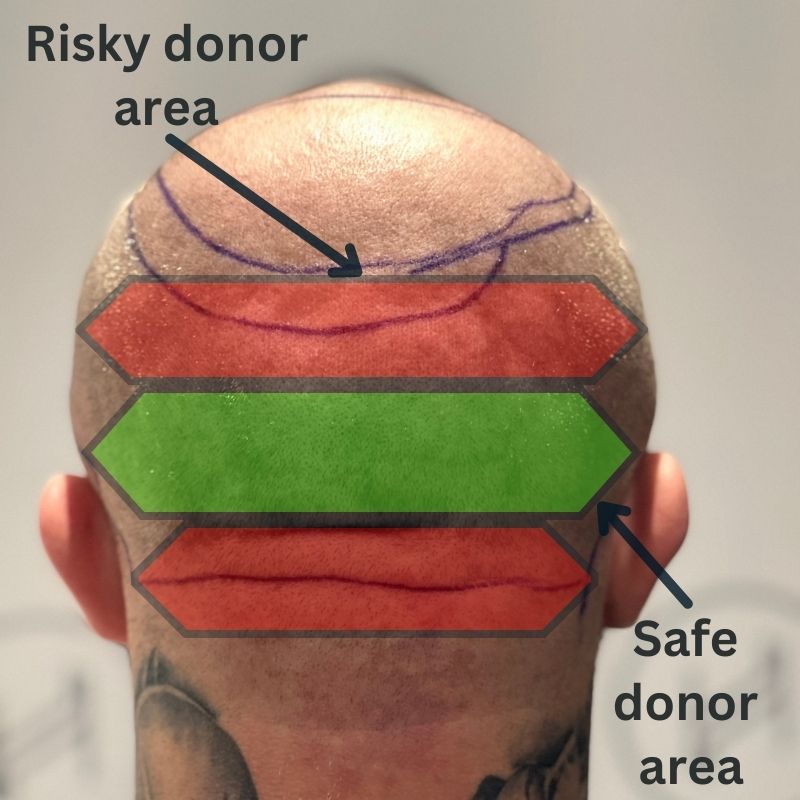hair transplant safe and risky donor areas