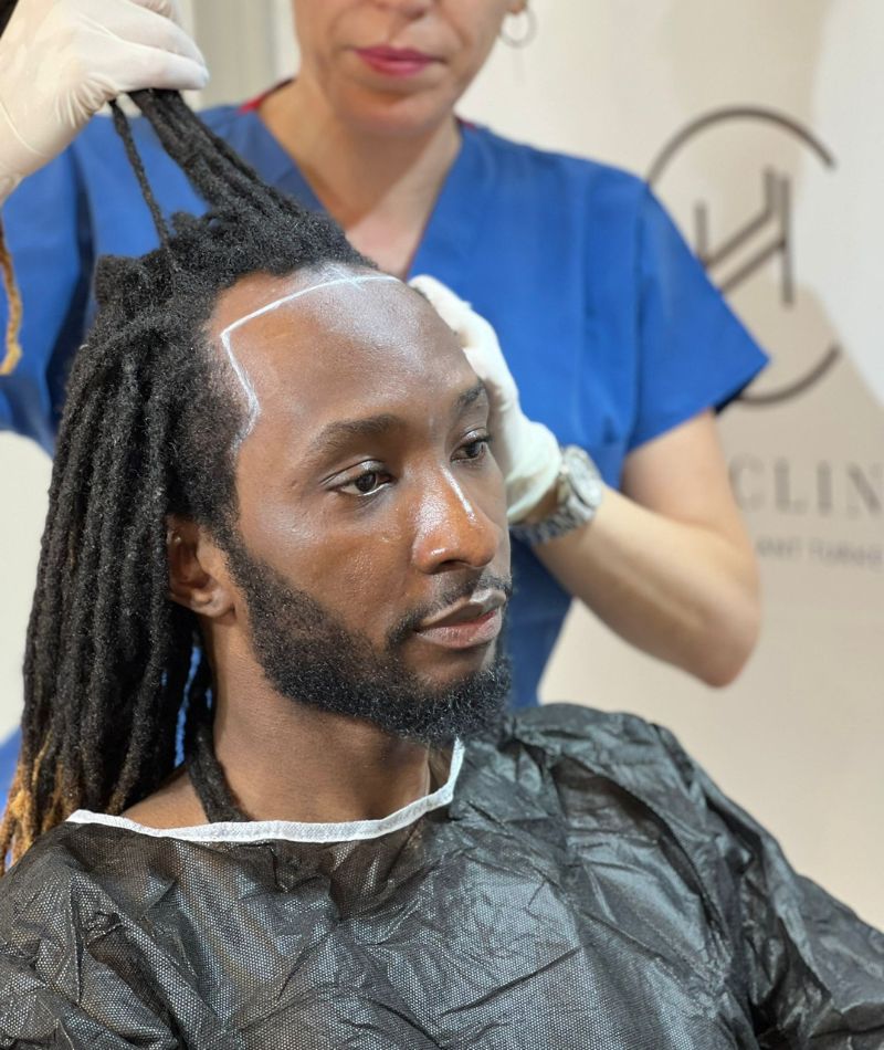 hair transplant with dreadlock hairline before operation heva clinic
