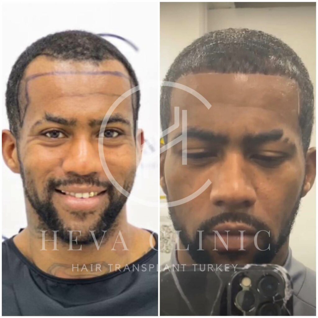 3000 grafts afro-textured hair transplant before and after result