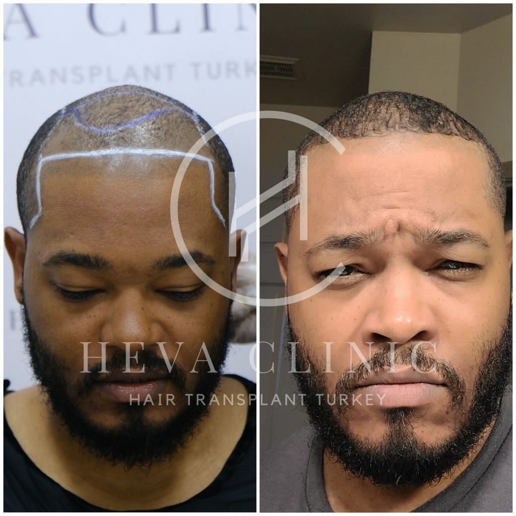 4000 graft hair transplant before and after