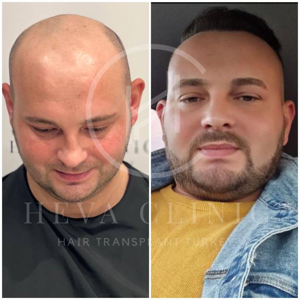 6000 graft hair transplant result Norwood 7