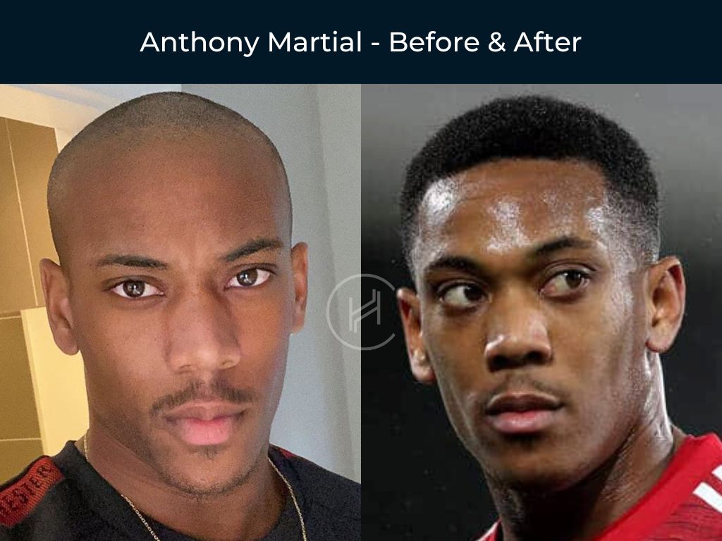 Anthony Martial Football Player - Hair Transplant Before & After