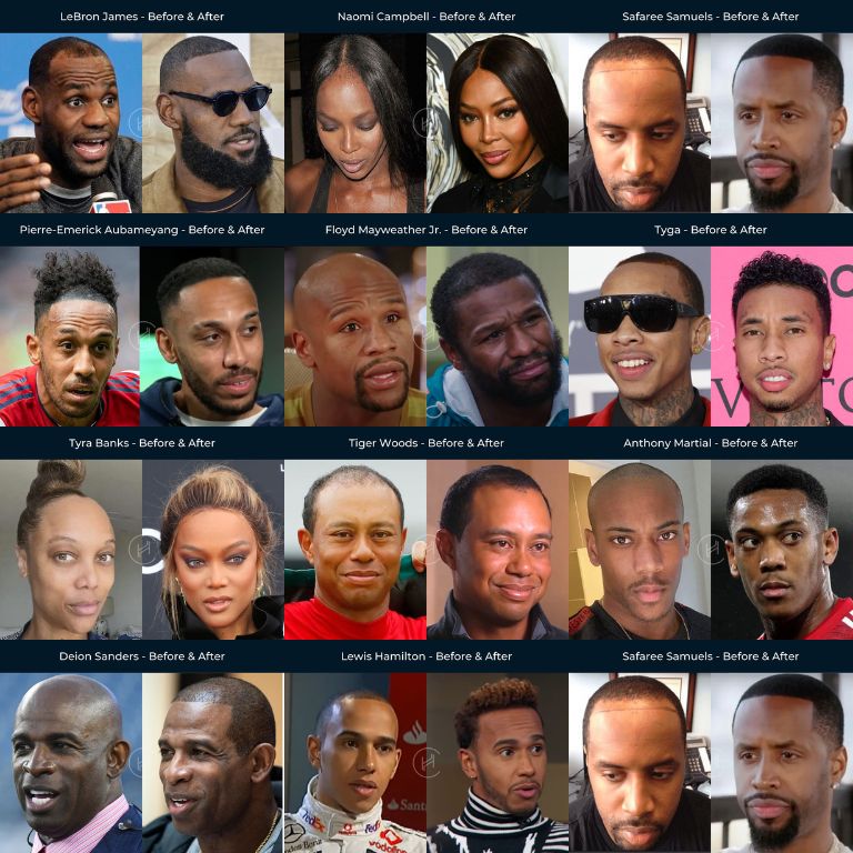 Black Celebrity Hair Transplants