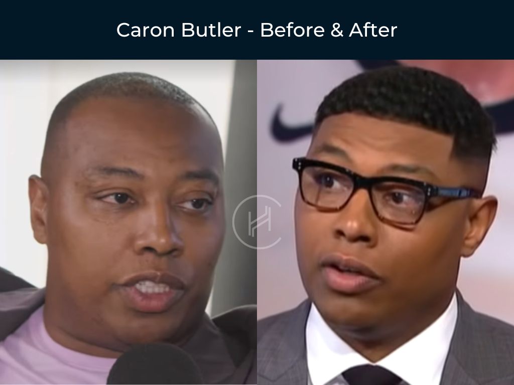 Caron Butler NBA Basketball Player - Hair Transplant Before & After