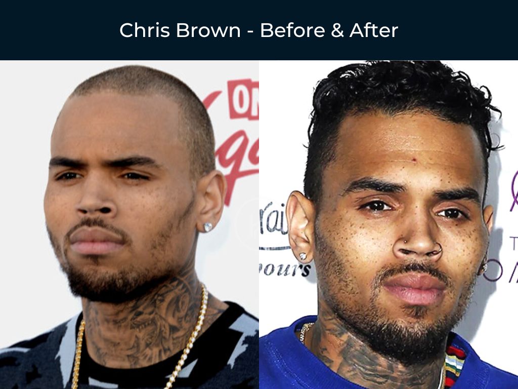 Chris Brown - Before & After Hair Transplant Photo Chris Brown - Before & After Hair Transplant Photo