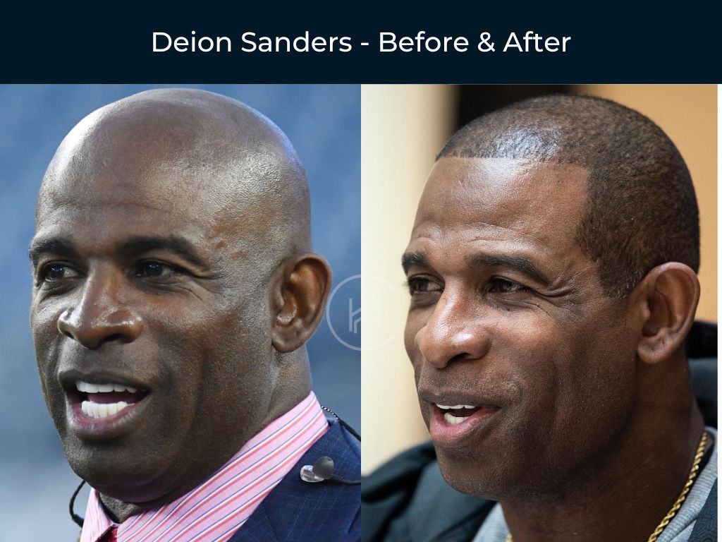 Deion Sanders - Hair Transplant Before & After Photo Deion Sanders - Hair Transplant Before & After Photo