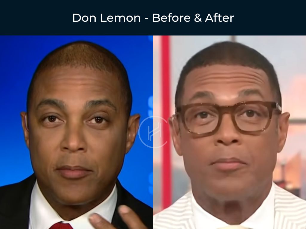 Don Lemon - Hair Transplant Before & After Don Lemon - Hair Transplant Before & After
