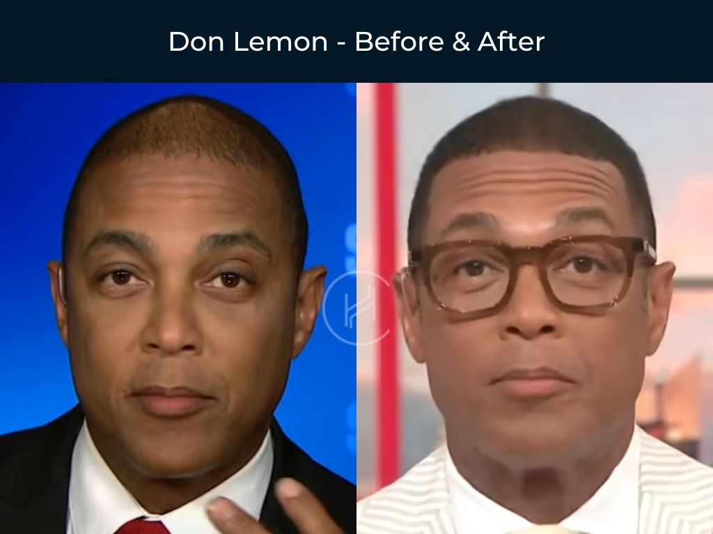 Don Lemon - Hair Transplant Before & After