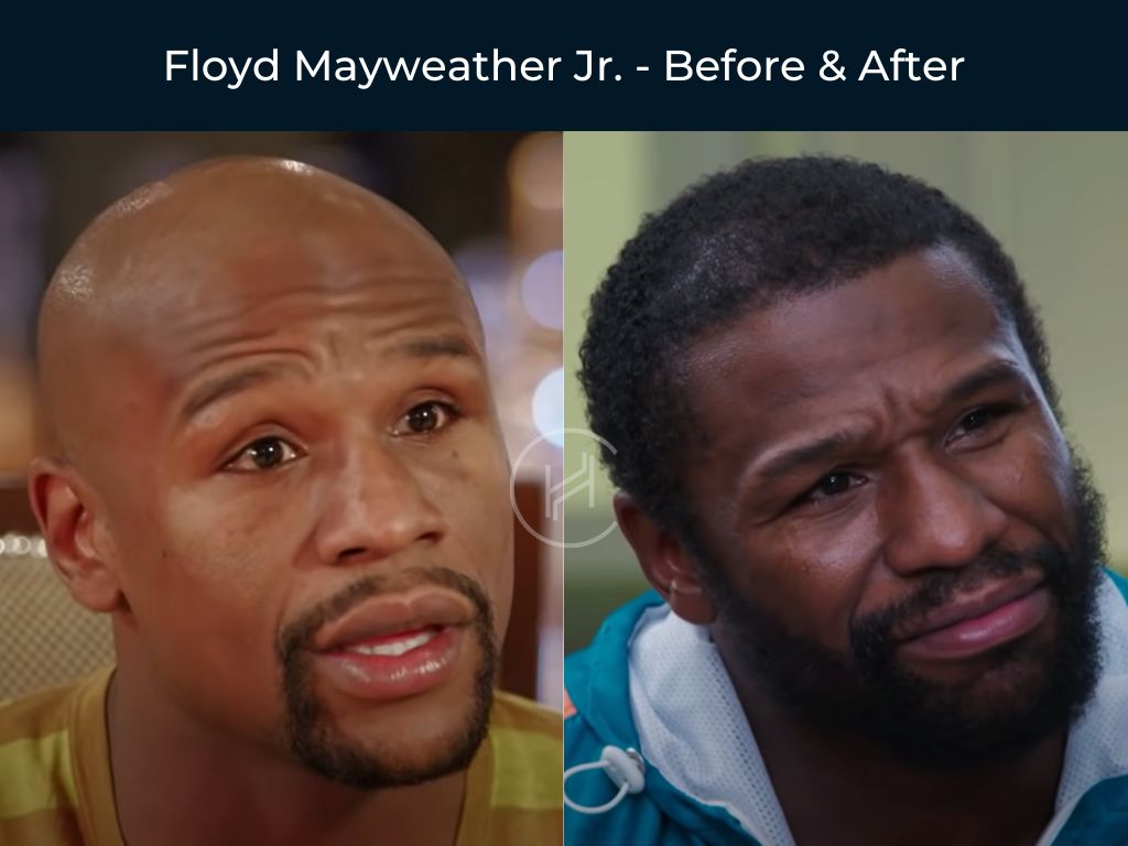 Floyd Mayweather Jr. - Hair Transplant Before & After