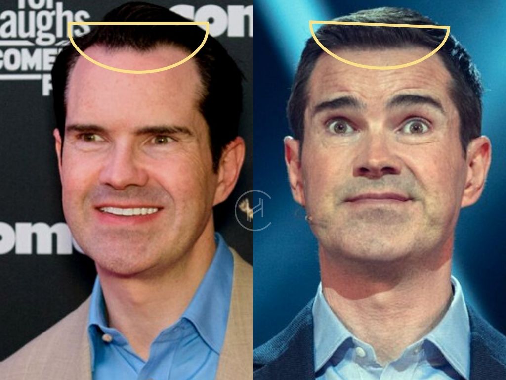 Hair Transplant Result Jimmy Carr Hairline Before and After Photo