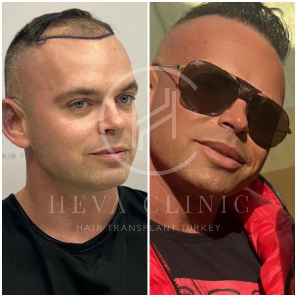 Hair transplant before and after norwood 4 patient 3900 graft