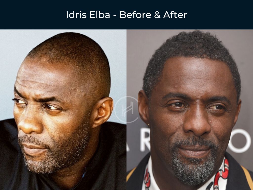 Idris Elba - Hair Transplant Before & After
