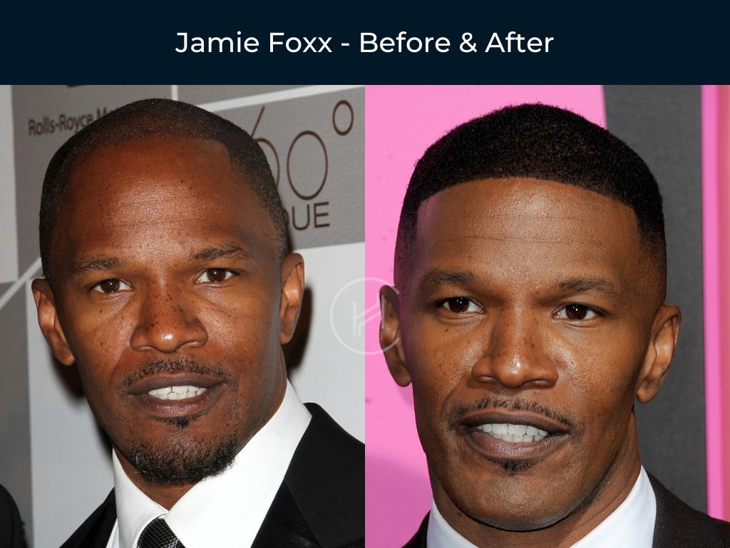 Jamie Foxx - Hair Transplant Before & After Photo Jamie Foxx - Hair Transplant Before & After Photo