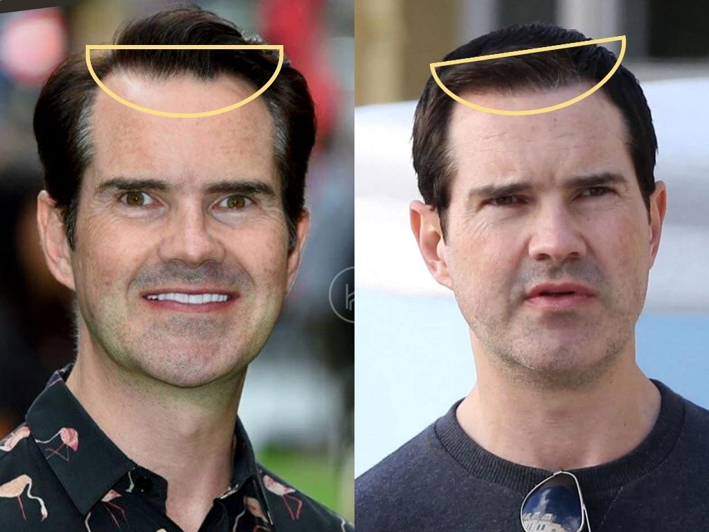 Jimmy Carr Before and After Hair Transplant Difference