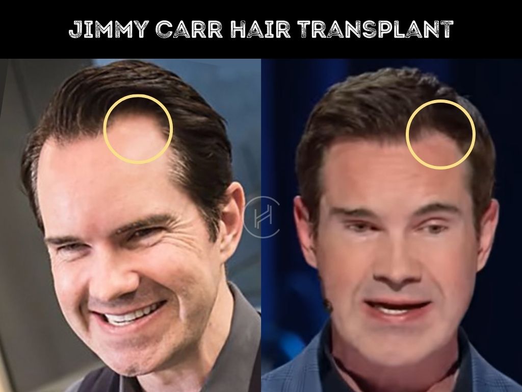 Jimmy Carr Hair Transplant Before and After