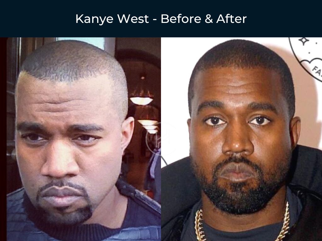 Kanye West - Hair Transplant Before & After Kanye West - Hair Transplant Before & After