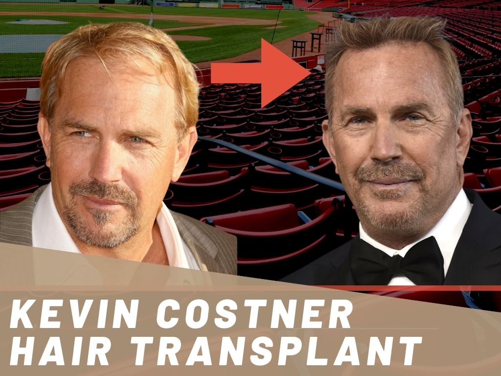 Kevin Costner Hair Transplant Banner Before and After