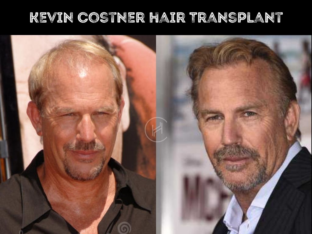 Kevin Costner Hair Transplant before and after