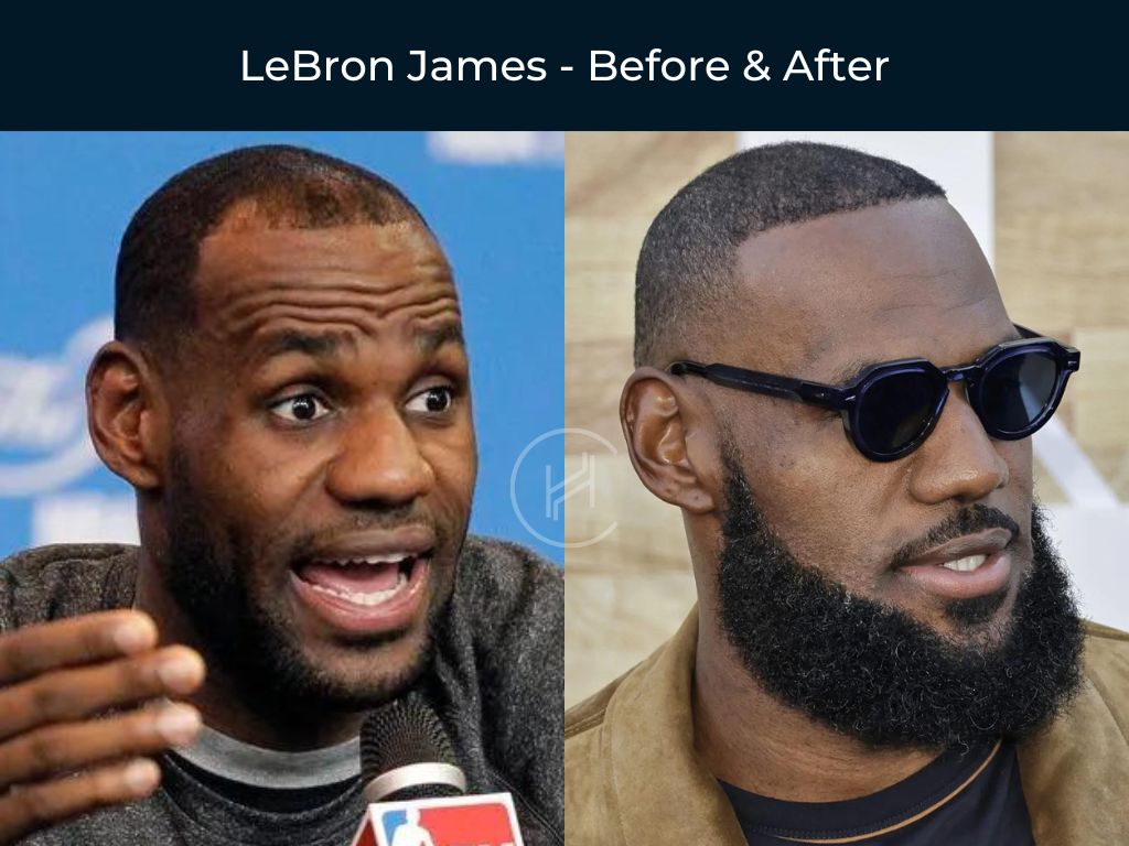 LeBron James - Hair Transplant Before & After Photo LeBron James - Hair Transplant Before & After Photo