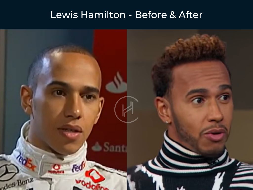 Lewis Hamilton - Hair Transplant Before & After Photo Lewis Hamilton - Hair Transplant Before & After Photo