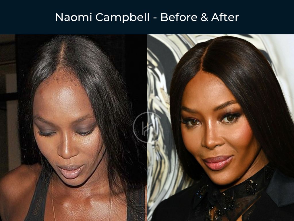 Naomi Campbell - Hair Transplant Before & After Photo