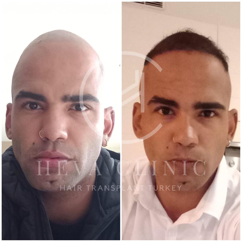 Norwood 6 hair transplant before and after 4500 graft
