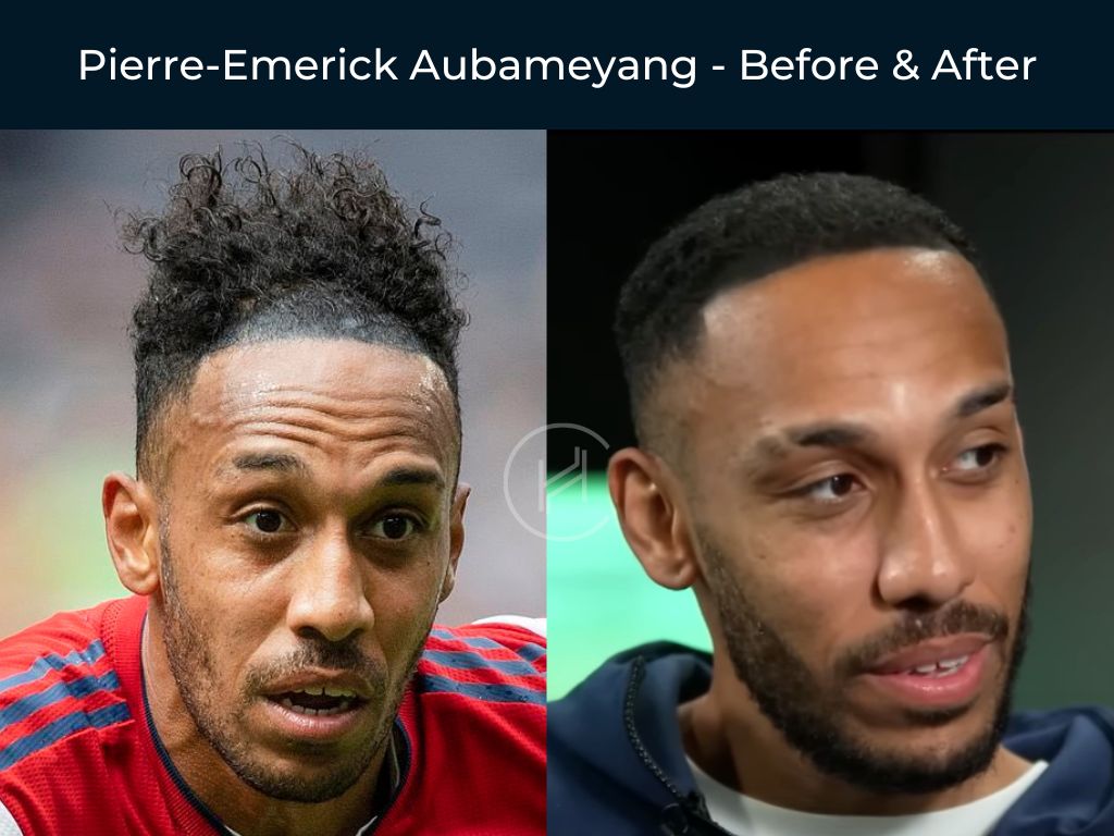 Pierre-Emerick Aubameyang Football Player- Hair Transplant Before & After