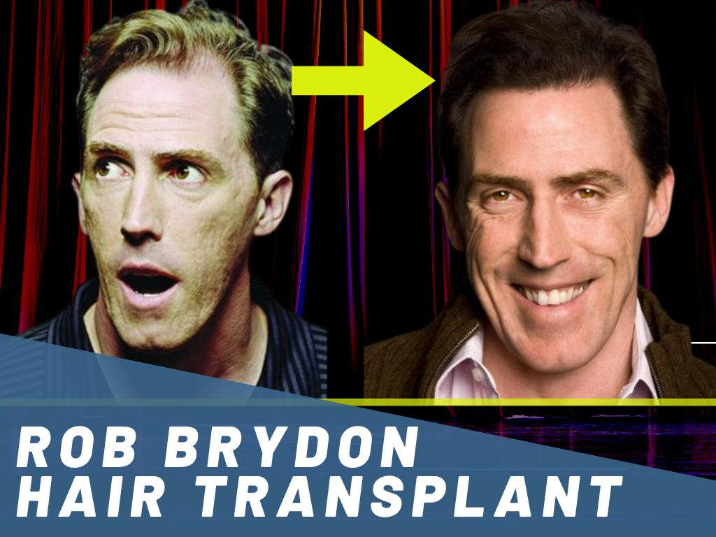 Rob Brydon Hair Transplant banner