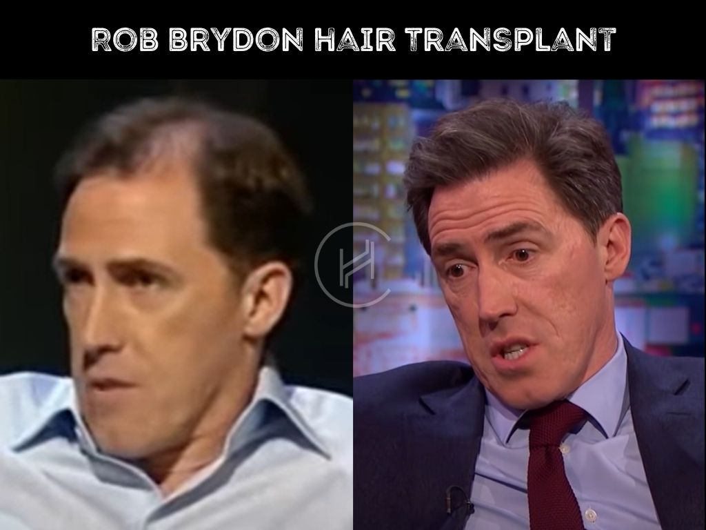 Rob Brydon hair transplant