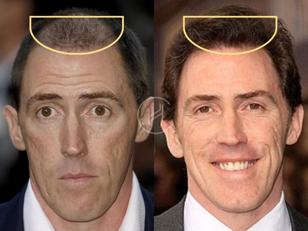 Rob brydon hair transplant before abd after hairline