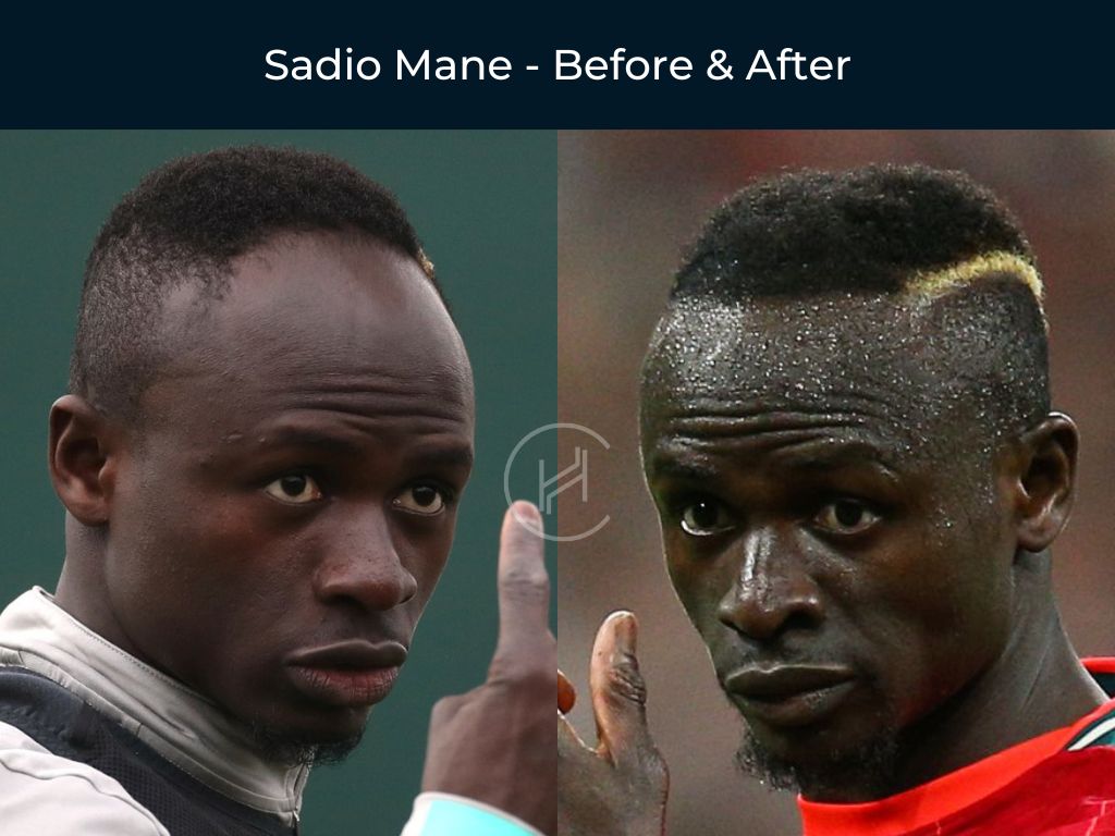 Sadio Mane Hair Transplant Before and After