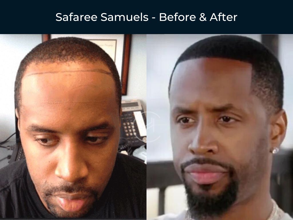 Safaree Samuels - Hair Transplant Before & After Safaree Samuels - Hair Transplant Before & After