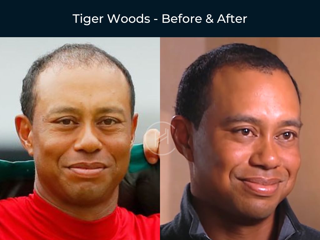 Tiger Woods - Hair Transplant Before & After Photo Tiger Woods - Hair Transplant Before & After Photo