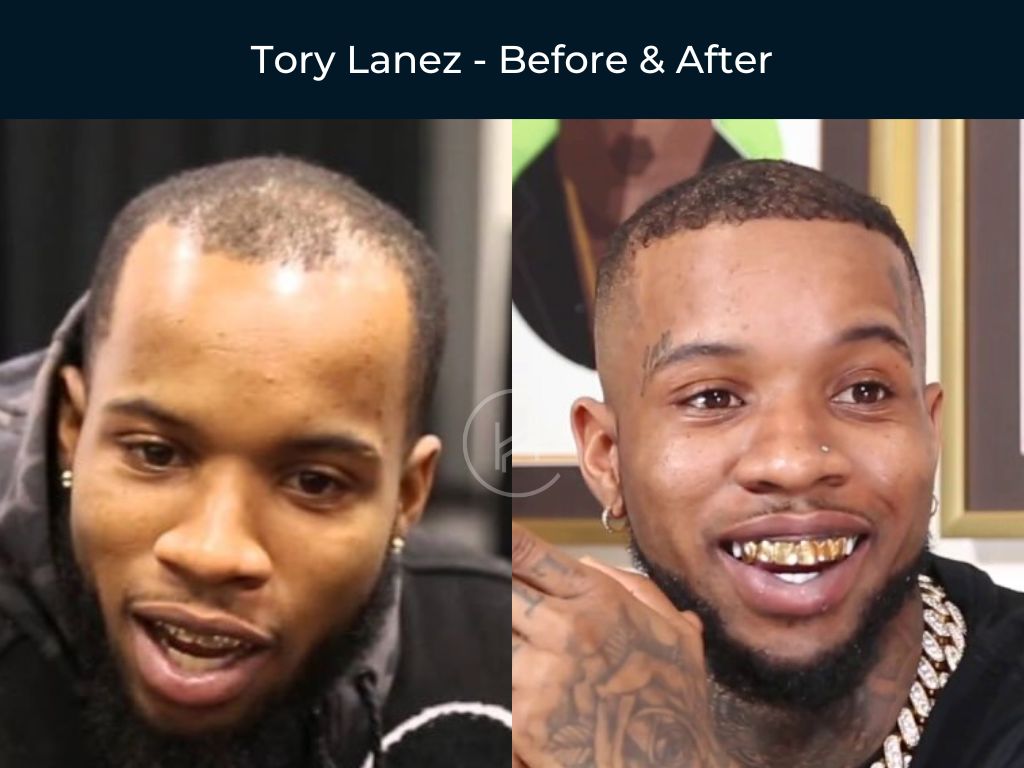 Tory Lanez - Hair Transplant Before & After Photo Tory Lanez - Hair Transplant Before & After Photo