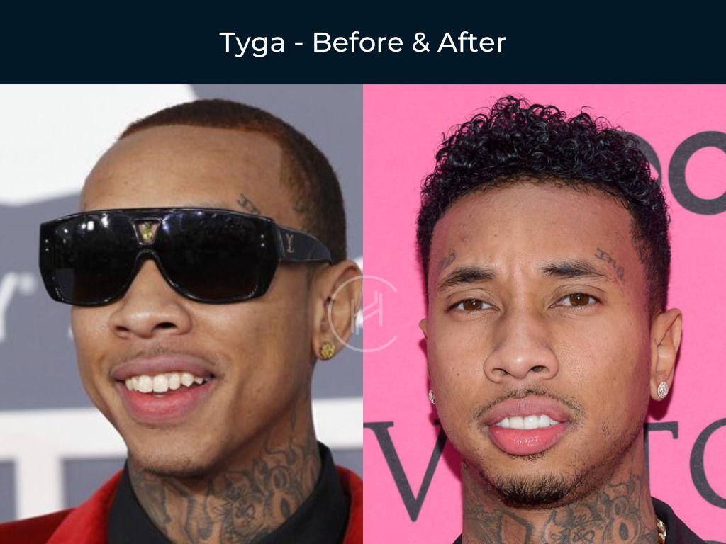Tyga - Hair Transplant Before & After Photo Tyga - Hair Transplant Before & After Photo