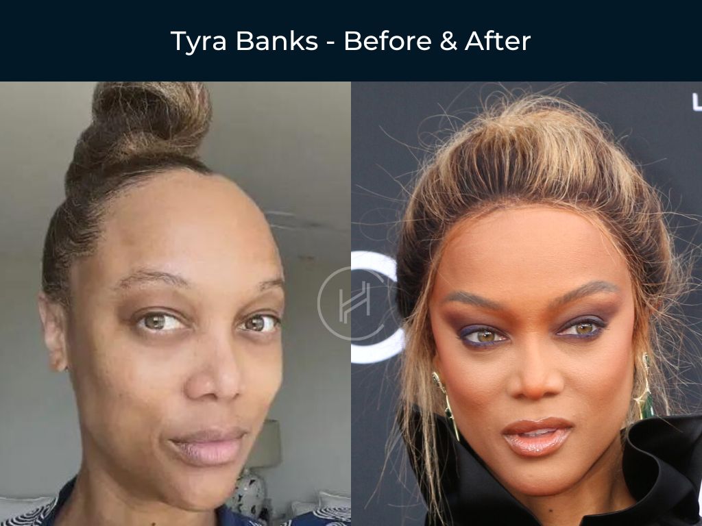 Tyra Banks - Hair Transplant Before & After