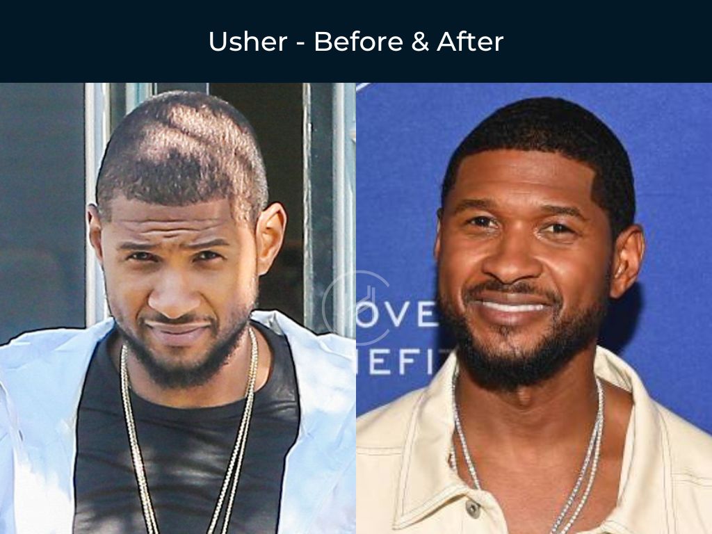 Usher - Hair Transplant Before & After Usher - Hair Transplant Before & After