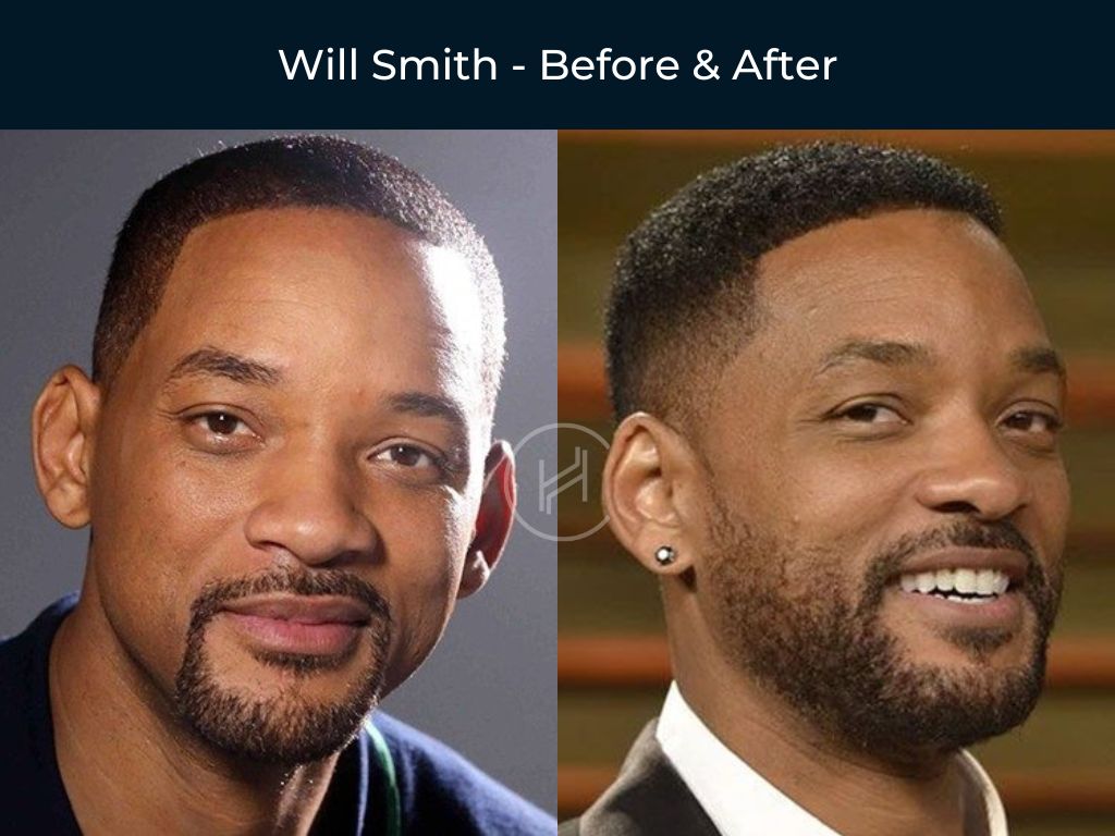 Will Smith - Hair Tansplant Before & After