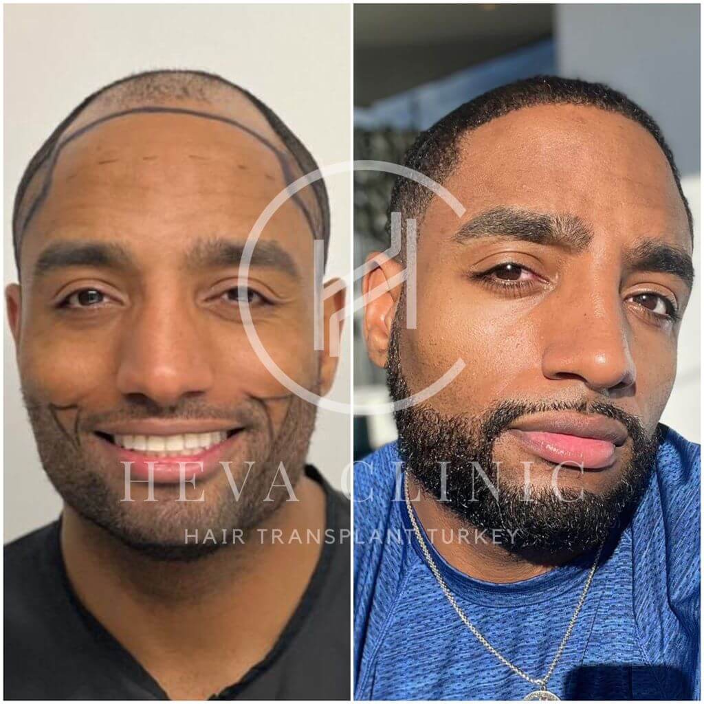 Afro Hair Transplant Before & After Photos Unfiltered Results