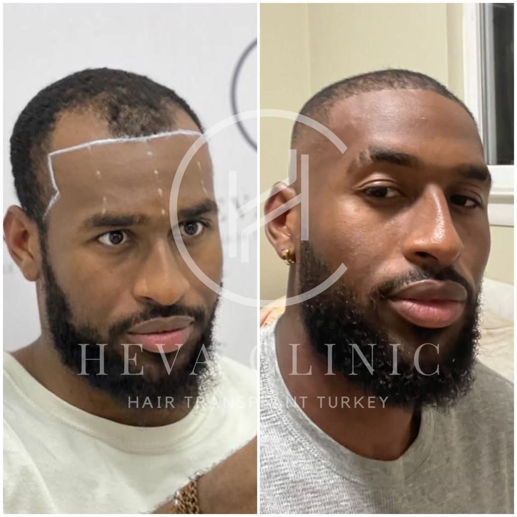 afro curly hair transplant before and after 2700 grafts