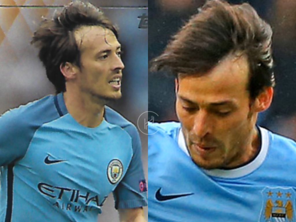 david silva hair loss temple area