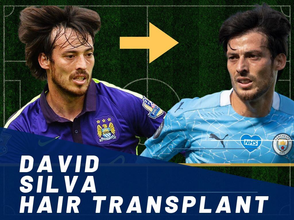 david silva hair transplant analysis