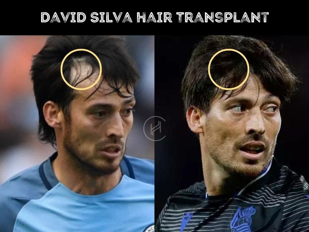 david silva hair transplant before and after