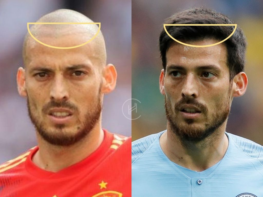 david silva shaved hair and hair transplant