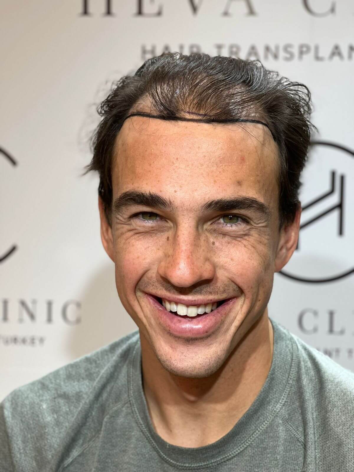 33+ diffuse thinning hair transplant - SumeyaAarith